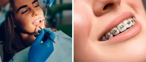 Aparelho fixo e estético